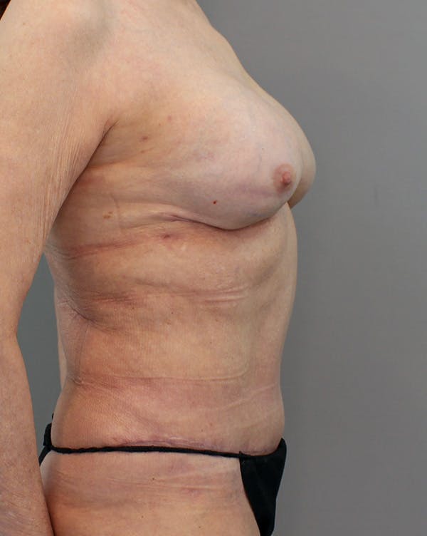 Hybrid Before & After Gallery - Patient 149051004 - Image 6
