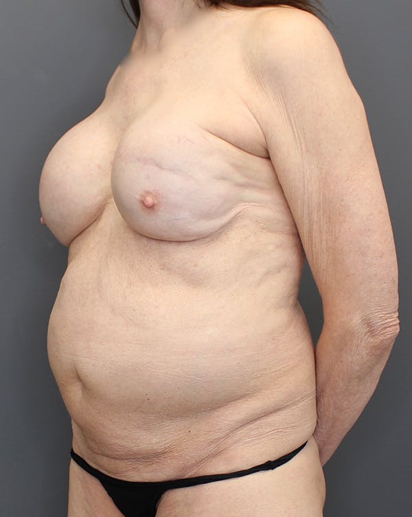 Hybrid Before & After Gallery - Patient 149051004 - Image 7