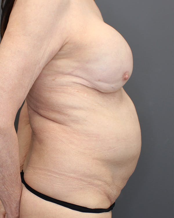 Hybrid Before & After Gallery - Patient 149051004 - Image 5