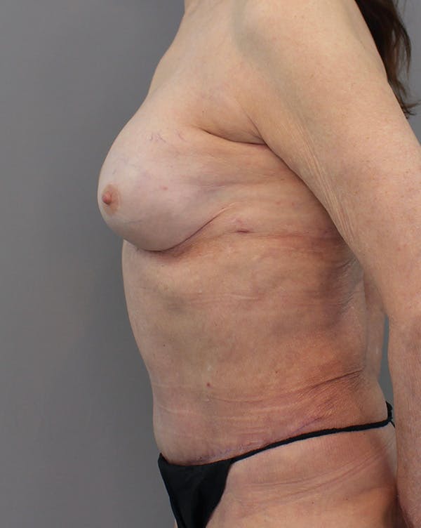 Hybrid Before & After Gallery - Patient 149051004 - Image 10