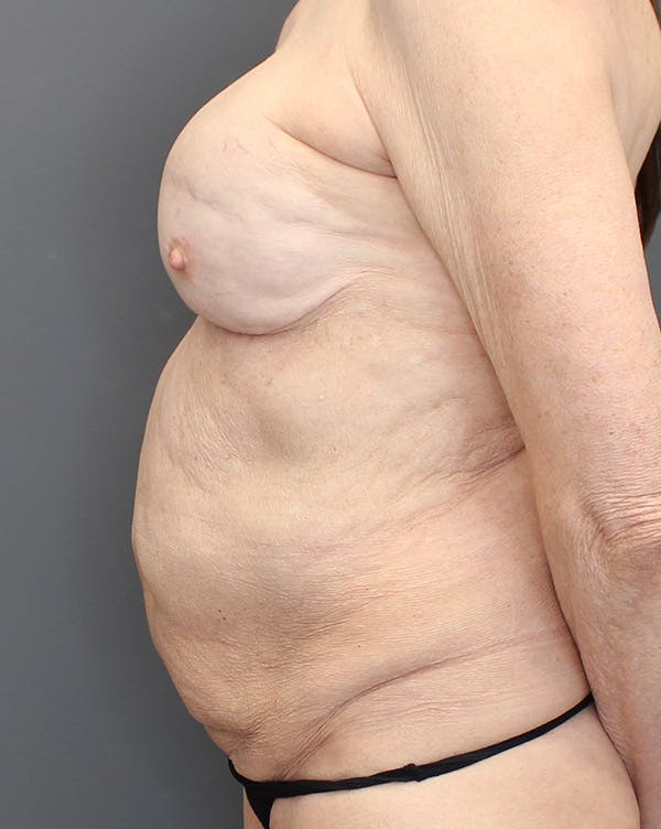 Hybrid Before & After Gallery - Patient 149051004 - Image 9