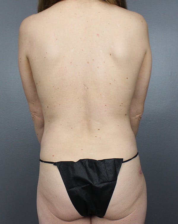 LAP Flap Before & After Gallery - Patient 149051010 - Image 13
