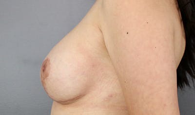 Staged Implant-Based Reconstruction Before & After Gallery - Patient 127411 - Image 10