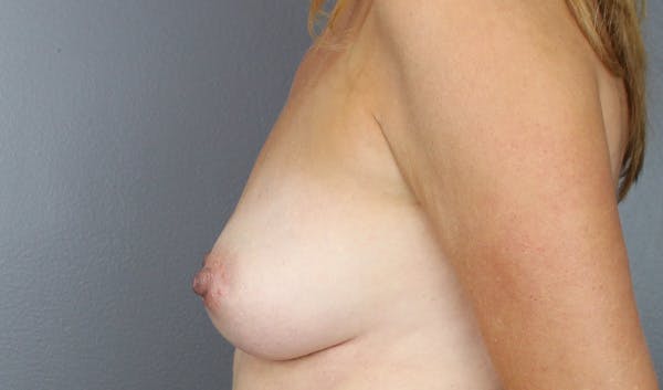 Staged Implant-Based Reconstruction Before & After Gallery - Patient 833388 - Image 9