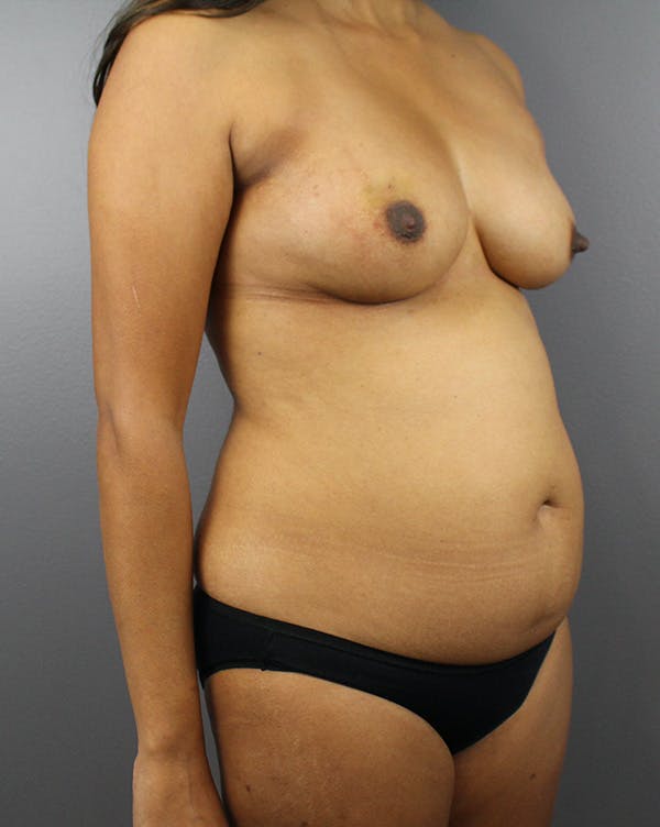DIEP Flap Before & After Gallery - Patient 212998 - Image 3