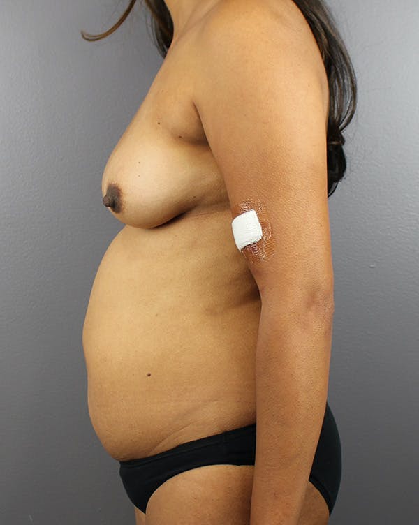 DIEP Flap Before & After Gallery - Patient 212998 - Image 9
