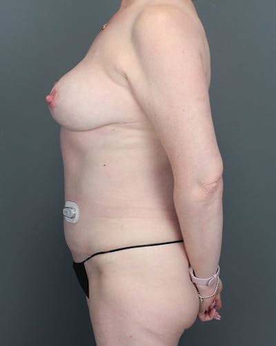 DIEP Flap Before & After Gallery - Patient 969173 - Image 10