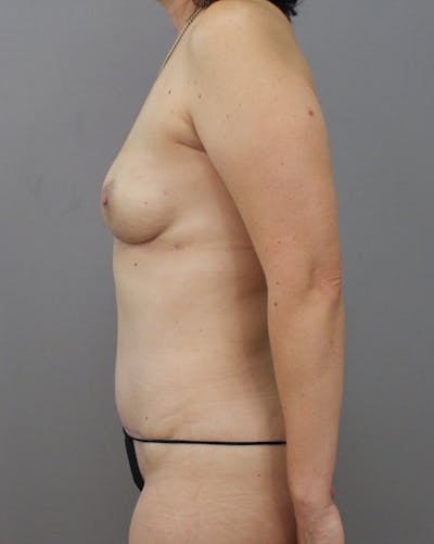 DIEP Flap Before & After Gallery - Patient 161839 - Image 10