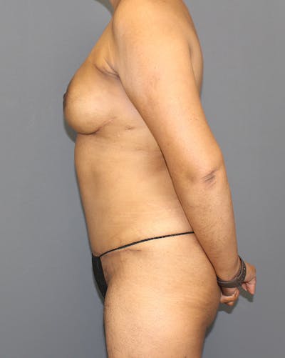 DIEP Flap Before & After Gallery - Patient 182741 - Image 10