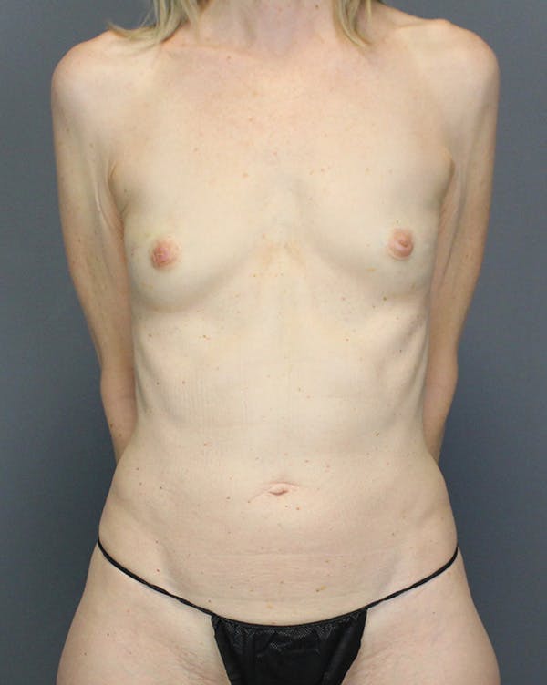 LAP Flap Before & After Gallery - Patient 392504 - Image 1