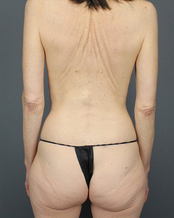 LAP Flap Before & After Gallery - Patient 392504 - Image 13