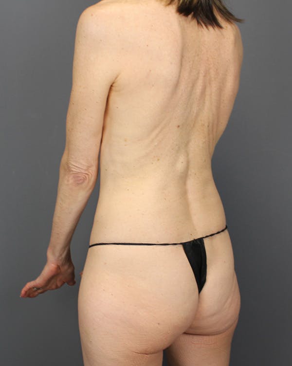 LAP Flap Before & After Gallery - Patient 392504 - Image 15