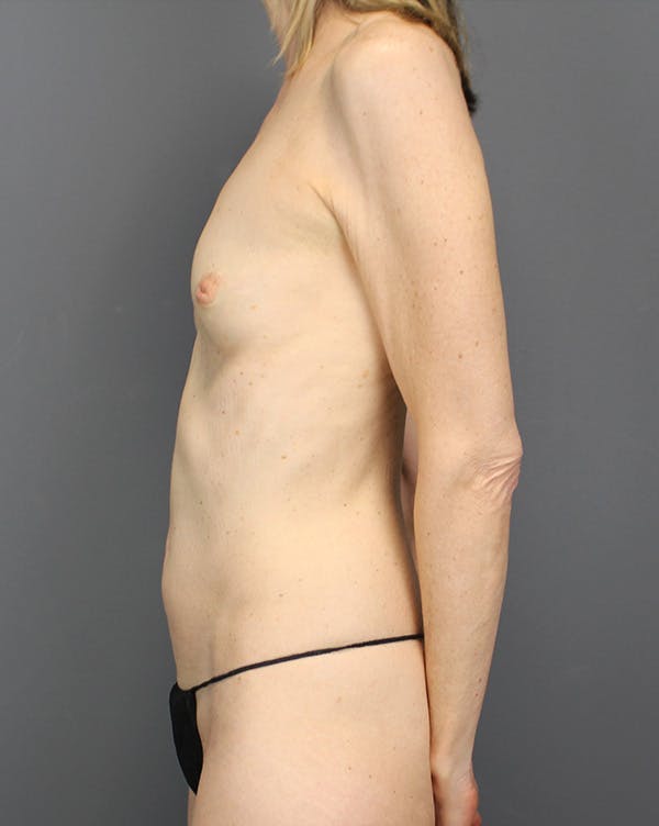 LAP Flap Before & After Gallery - Patient 392504 - Image 9