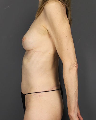 LAP Flap Before & After Gallery - Patient 392504 - Image 10