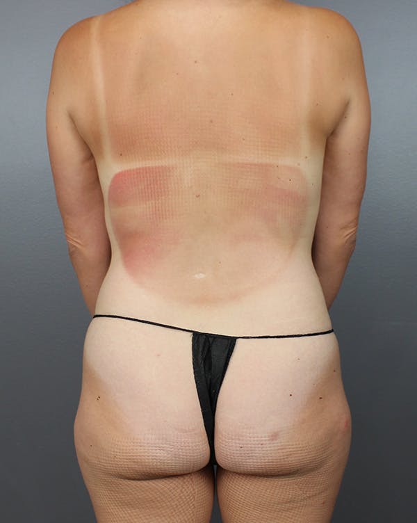 LAP Flap Before & After Gallery - Patient 272140 - Image 9