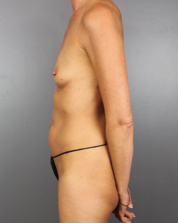 Hybrid Before & After Gallery - Patient 211845 - Image 9