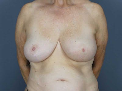 Oncoplastic Reconstruction Before & After Gallery - Patient 320907 - Image 2