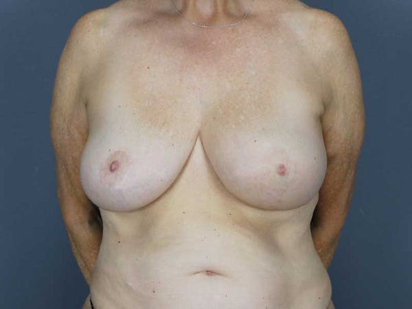 Oncoplastic Reconstruction Before & After Gallery - Patient 320907 - Image 2