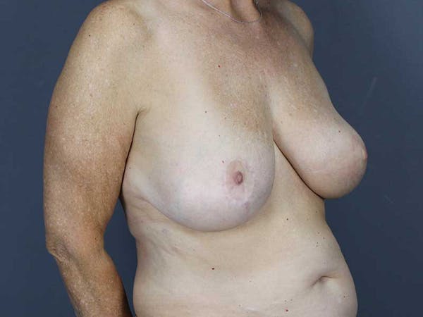 Oncoplastic Reconstruction Before & After Gallery - Patient 320907 - Image 8