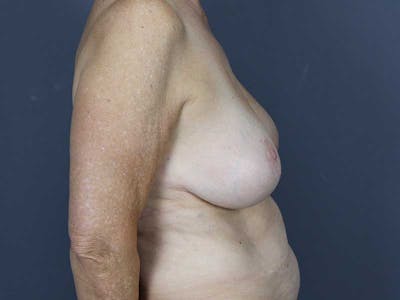 Oncoplastic Reconstruction Before & After Gallery - Patient 320907 - Image 10