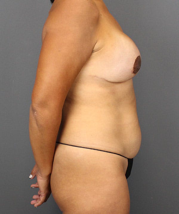 DIEP Flap Before & After Gallery - Patient 138677 - Image 7