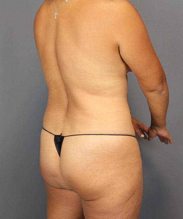 DIEP Flap Before & After Gallery - Patient 138677 - Image 12