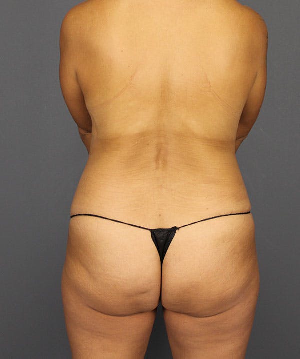 DIEP Flap Before & After Gallery - Patient 138677 - Image 9