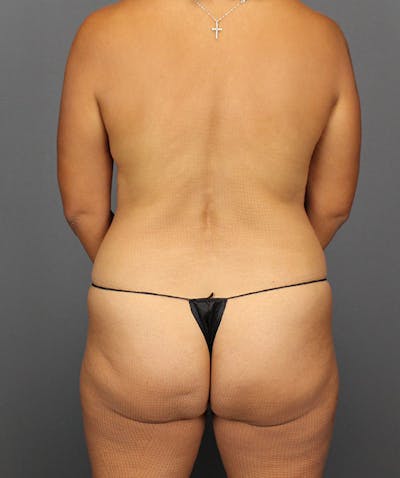 DIEP Flap Before & After Gallery - Patient 138677 - Image 10