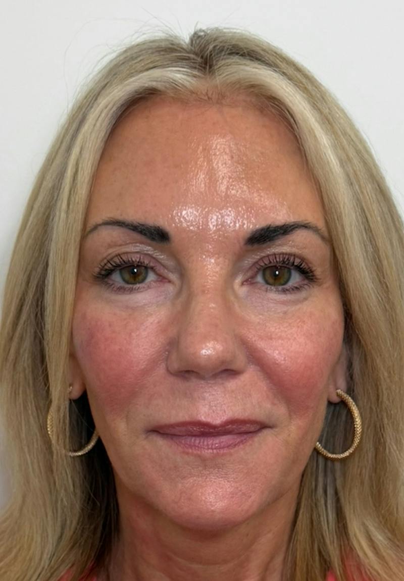 Results Before & After Gallery - Patient 285263 - Image 2