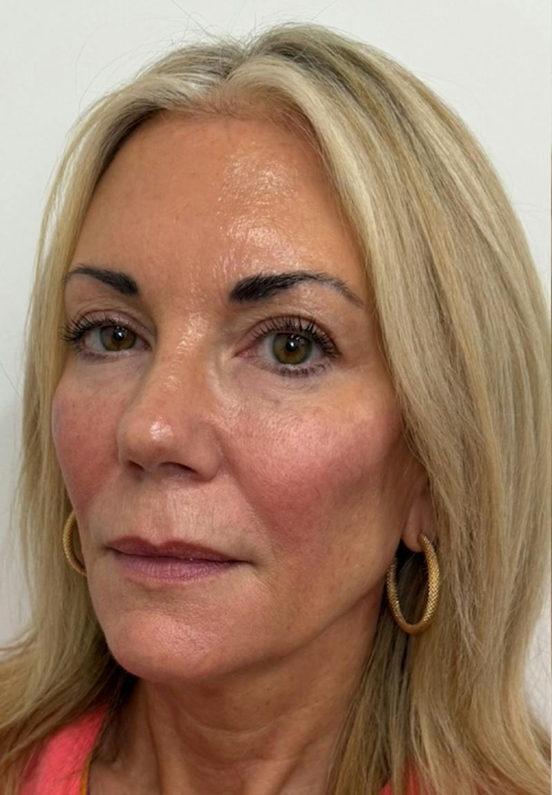 Results Before & After Gallery - Patient 285263 - Image 4
