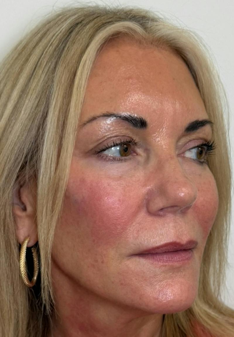 Results Before & After Gallery - Patient 285263 - Image 6