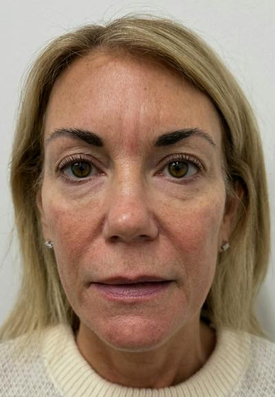 Results Before & After Gallery - Patient 285263 - Image 1