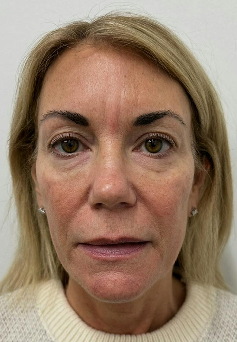Results Before & After Gallery - Patient 285263 - Image 1