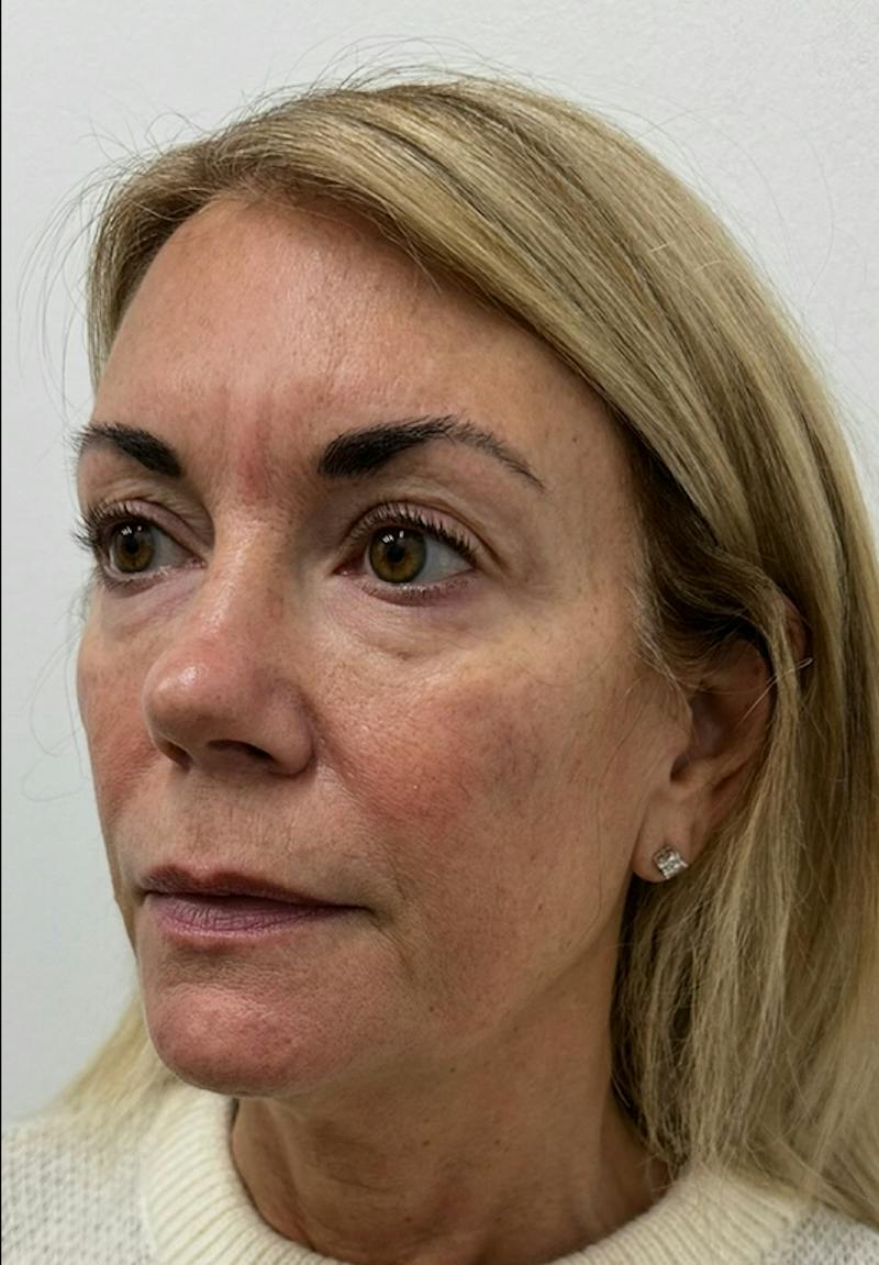 Results Before & After Gallery - Patient 285263 - Image 3