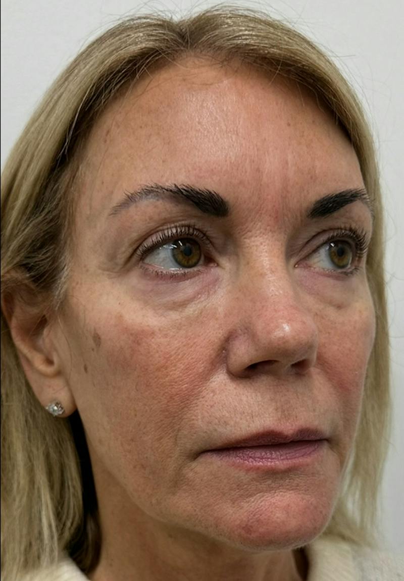 Results Before & After Gallery - Patient 285263 - Image 5