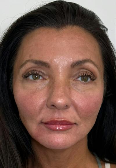 Results Before & After Gallery - Patient 550979 - Image 2