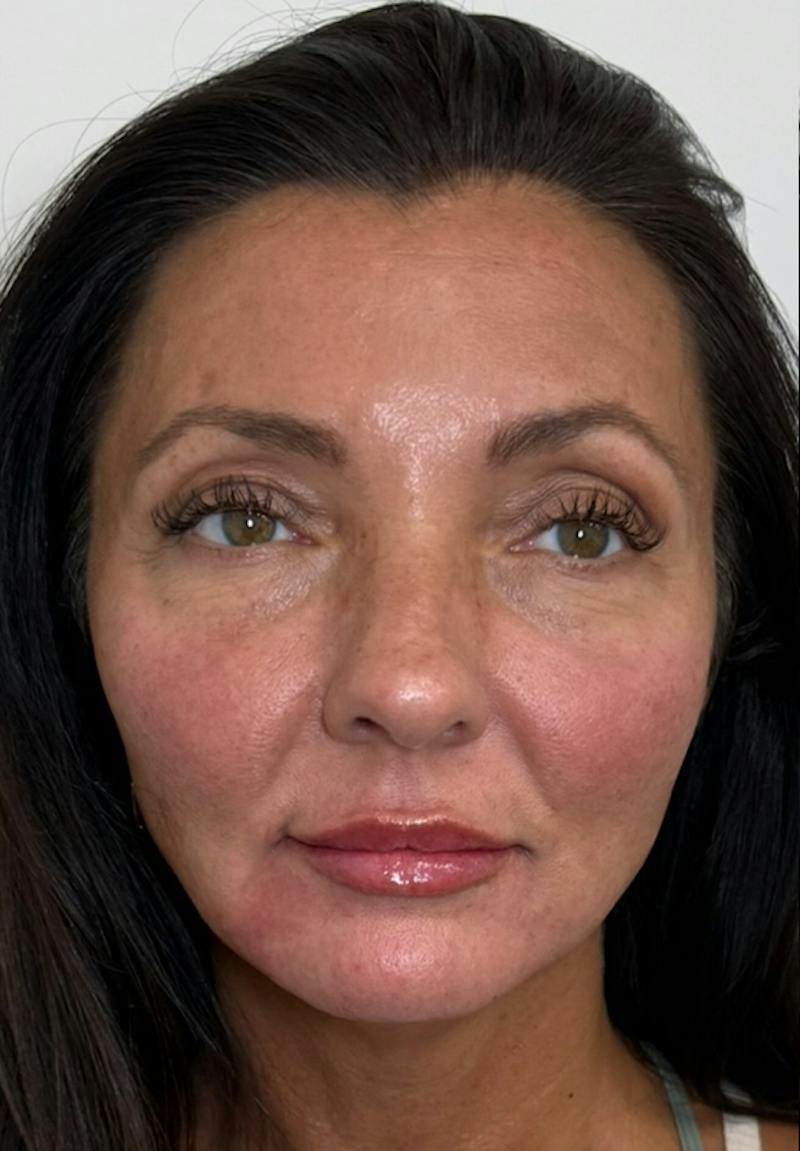 Results Before & After Gallery - Patient 550979 - Image 2