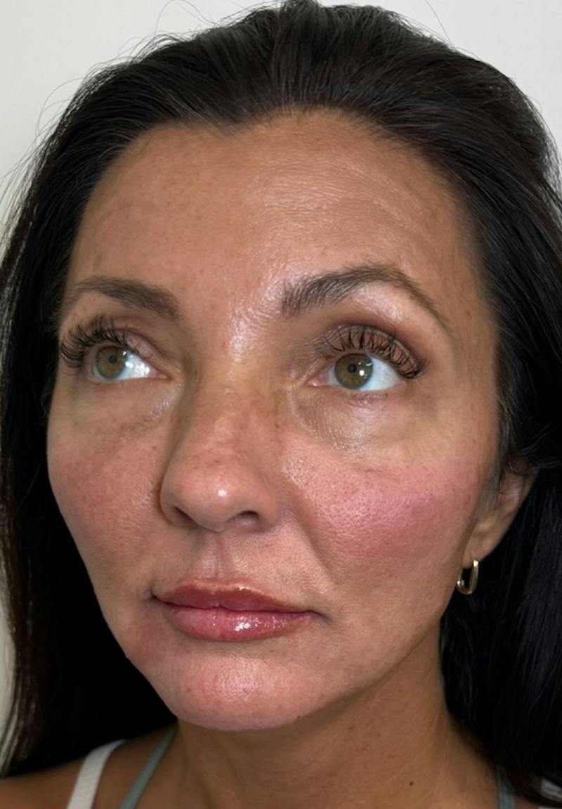 Results Before & After Gallery - Patient 550979 - Image 4