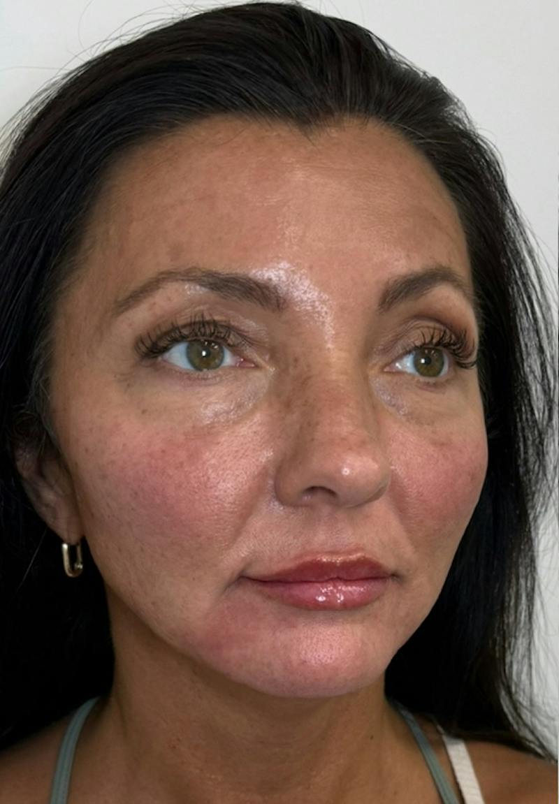 Results Before & After Gallery - Patient 550979 - Image 6