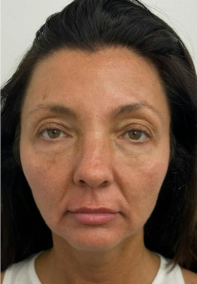 Results Before & After Gallery - Patient 550979 - Image 1