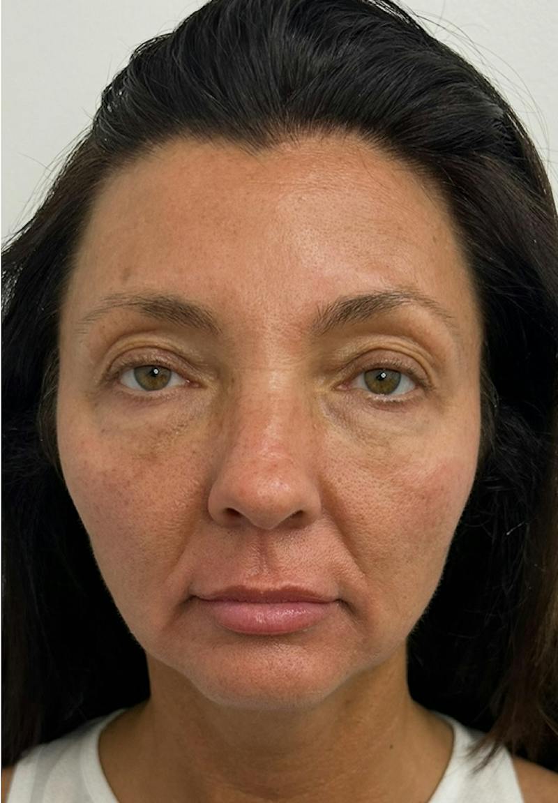 Results Before & After Gallery - Patient 550979 - Image 1