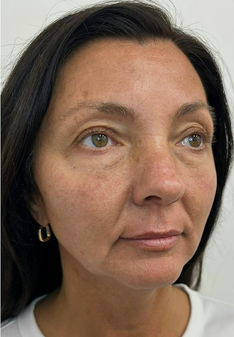 Results Before & After Gallery - Patient 550979 - Image 5