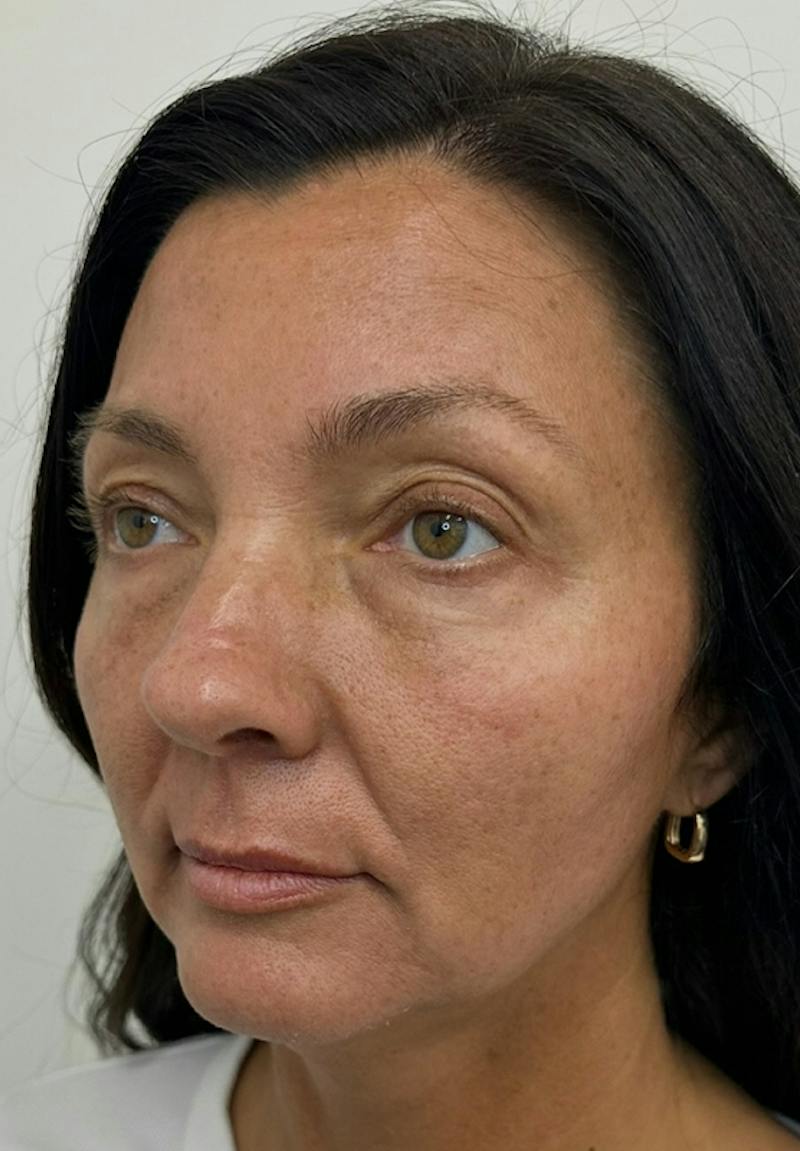 Results Before & After Gallery - Patient 550979 - Image 3