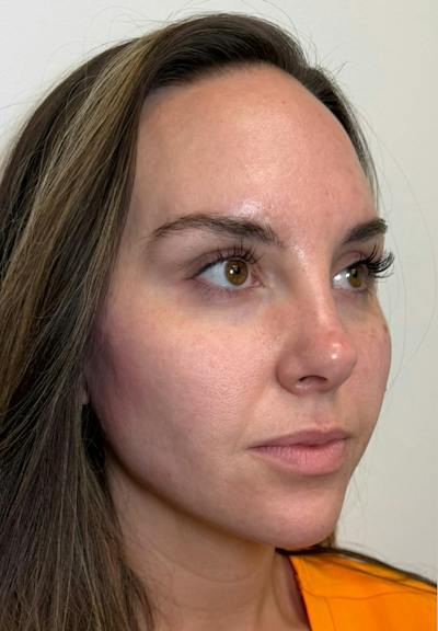 Results Before & After Gallery - Patient 390797 - Image 2