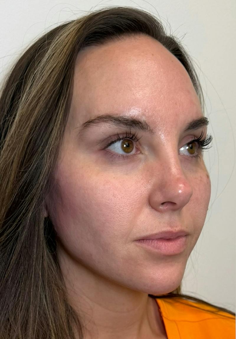 Results Before & After Gallery - Patient 390797 - Image 2