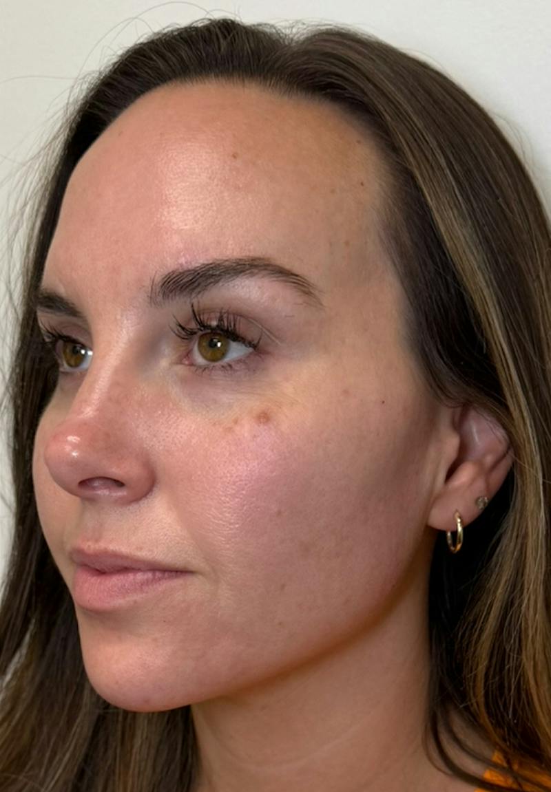 Results Before & After Gallery - Patient 390797 - Image 4