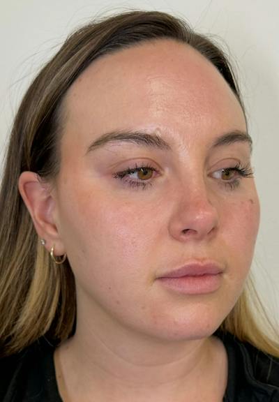 Results Before & After Gallery - Patient 390797 - Image 1