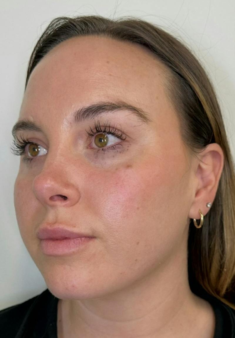 Results Before & After Gallery - Patient 390797 - Image 3