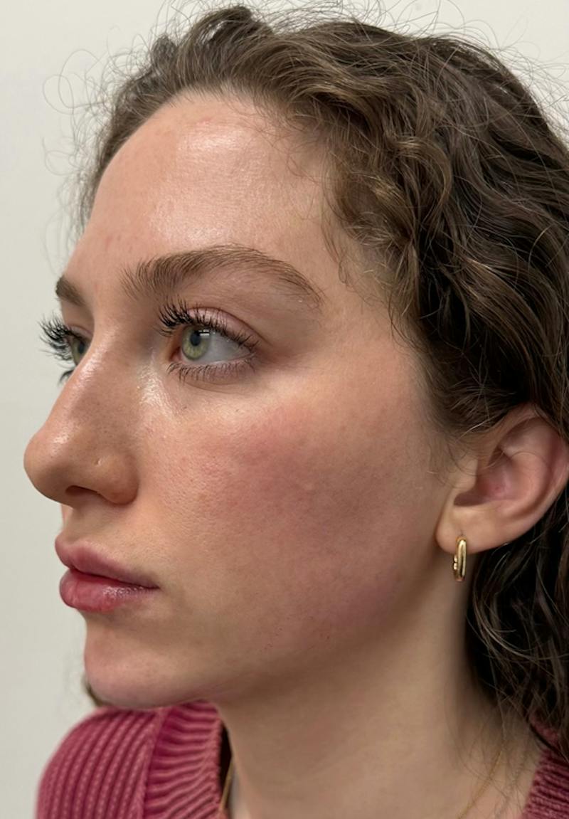 Results Before & After Gallery - Patient 298739 - Image 4