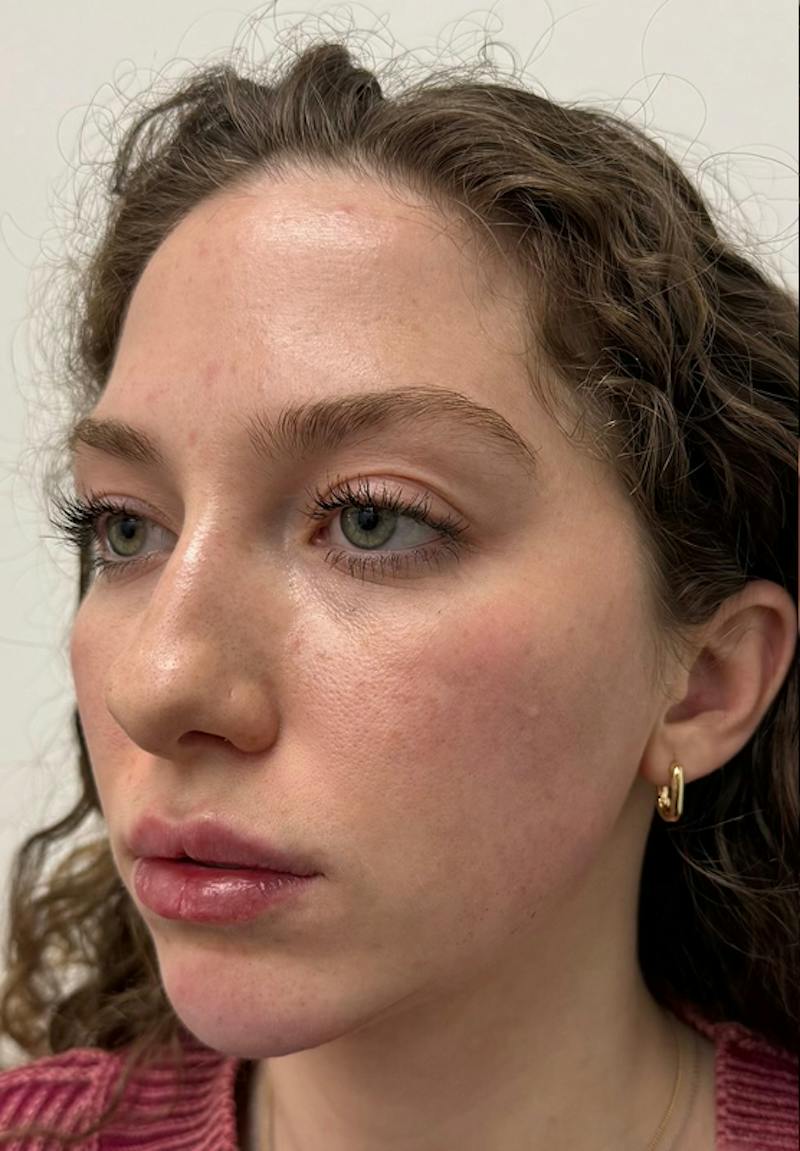 Results Before & After Gallery - Patient 298739 - Image 2